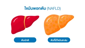 ตับปกติ vs ตับที่มีไขมันสะสม