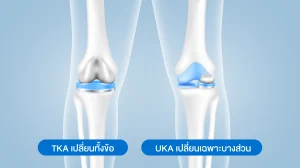 ผ่าตัดเปลี่ยนข้อเข่าเทียม TKA vs UKA
