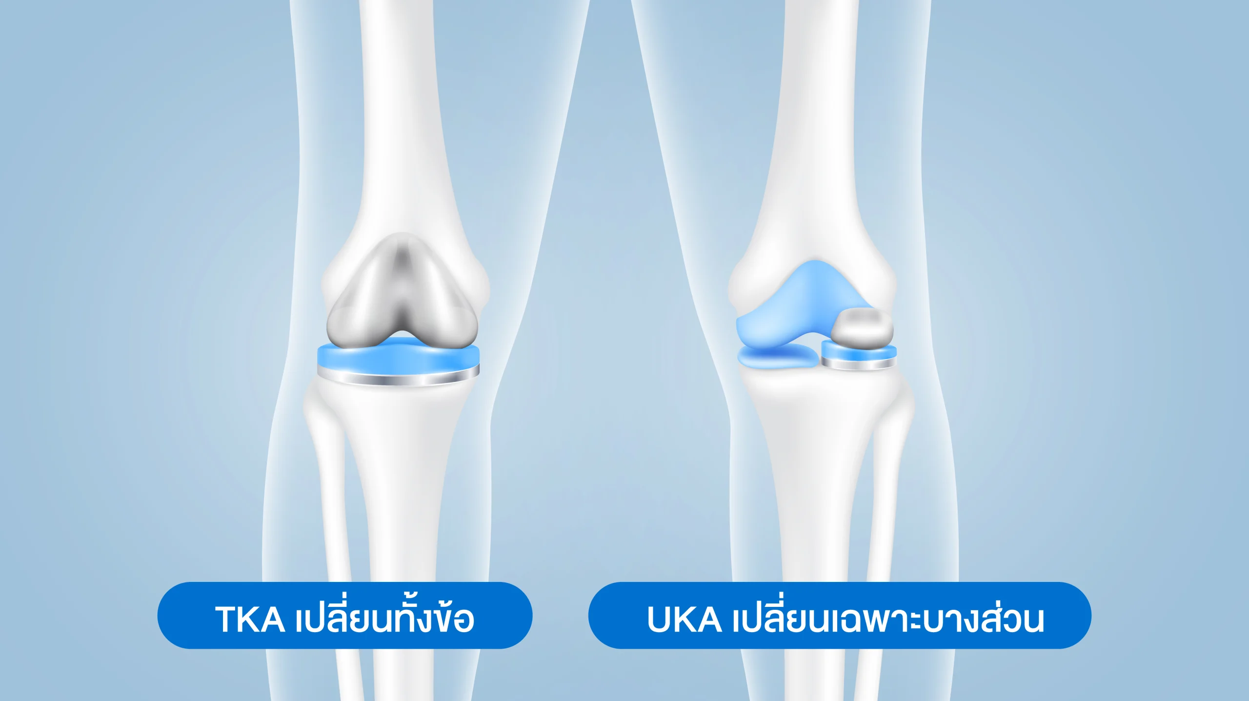 ผ่าตัดเปลี่ยนข้อเข่าเทียม TKA vs UKA