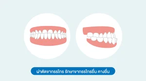 ผ่าตัดขากรรไกร รักษาขากรรไกรยื่น
