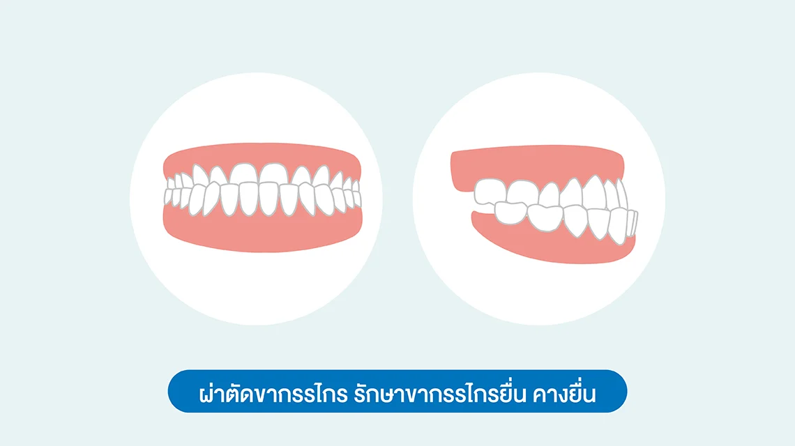 ผ่าตัดขากรรไกร รักษาขากรรไกรยื่น