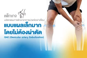 แพ็กเกจรักษาข้อเข่าเสื่อมด้วย GAE โรงพยาบาลธนบุรี บำรุงเมือง