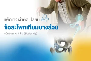 แพ็กเกจผ่าตัดเปลี่ยนข้อสะโพกเทียม โรงพยาบาลธนบุรี บำรุงเมือง