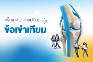 แพ็กเกจผ่าตัดเปลี่ยนข้อเข่าเทียม (TKA) โรงพยาบาลธนบุรี บำรุงเมือง